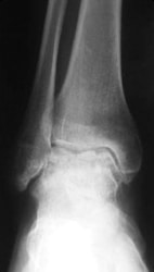 Ankle arthritis
