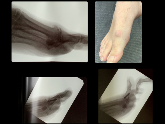Top row images show patient's foot with Hallux Rigidus before treatment, showing bony spurs at the great toe MPTJ. Bottom row shows x-rays after Cheilectomy with toe pinned.