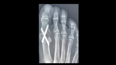 Patient with Hallux Rigidus, after arthrodesis fusion treatment
